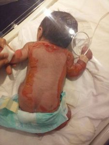 Bebé con quemaduras 1