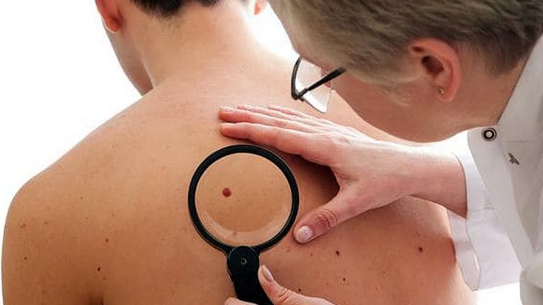 Melanoma en Fase II: vacuna argentina logra avances «prometedores»