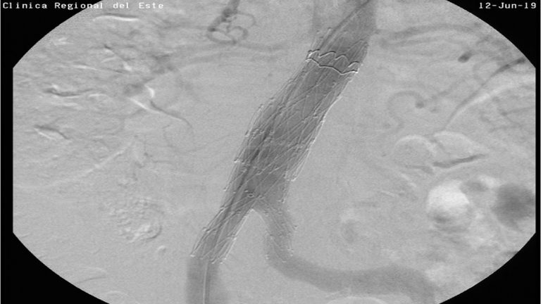Se realizó un tratamiento endovascular con un aneurisma de aorta abdominal en la ciudad