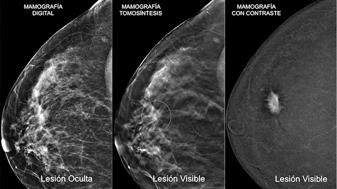 El Carcinoma Ductal In Situ Diario San Francisco