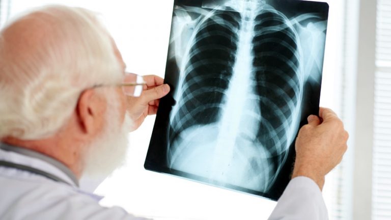 ANMAT aprobó un tratamiento innovador contra cáncer de pulmón en Argentina