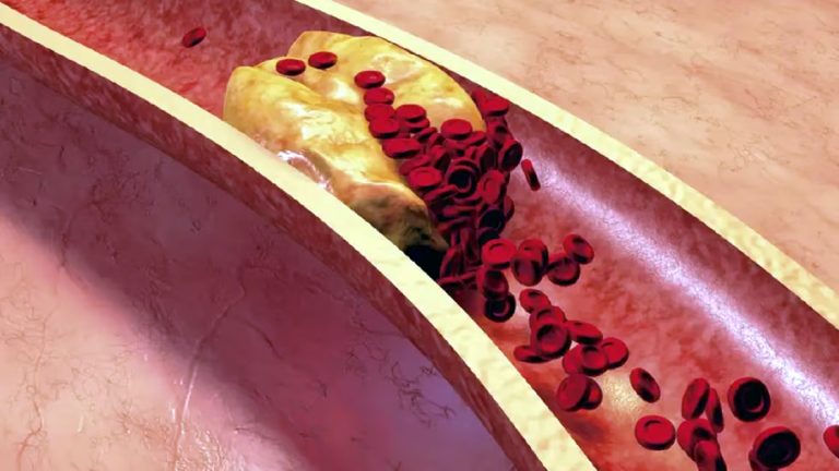 Un laboratorio argentino lanzó un remedio para bajar el colesterol sin efectos adversos musculares